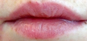 Dry & Cracked Lips
